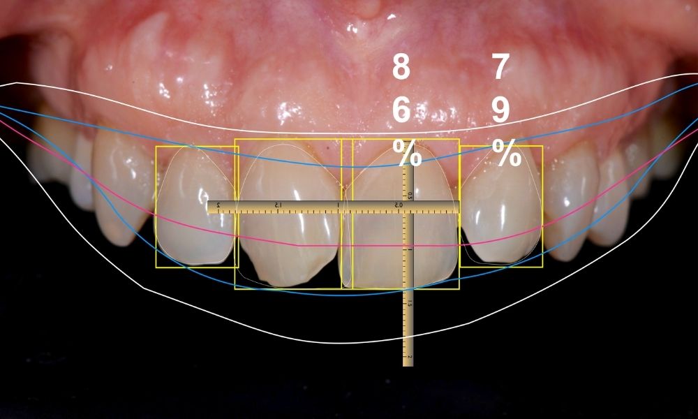 Intervento per modificare forma, colore e dimensione dei denti